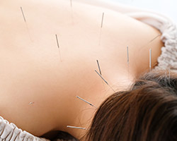 鍼灸
