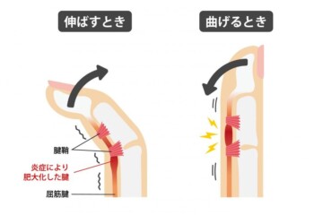 湿布では治らない？その痛みの原因とばね指改善に必要なケアとはの画像