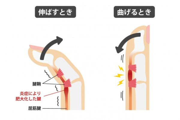湿布では治らない？その痛みの原因とばね指改善に必要なケアとはサムネイル